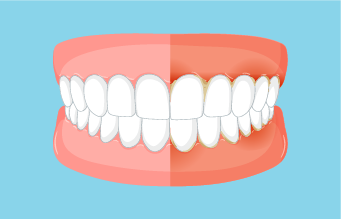 gengiva inflamada - gengivite