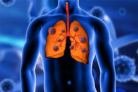 Trato Respiratório Superior – Tosse Seca